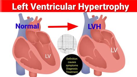 lvh medical abbreviation|is left ventricular hypertrophy considered heart failure.